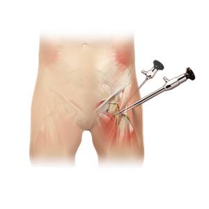 Picture of Hip Arthroscopy