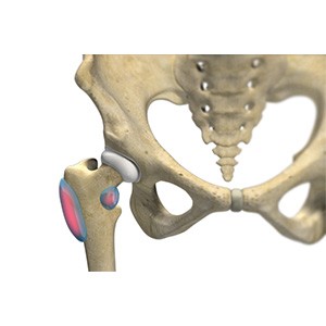 Picture of Hip Bursitis