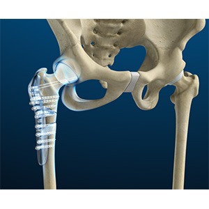 Picture of Hip Fracture Surgery