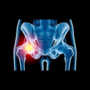 Picture of Hip Injury