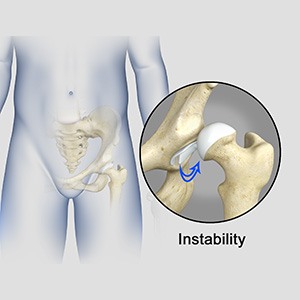 Picture of Hip Instability