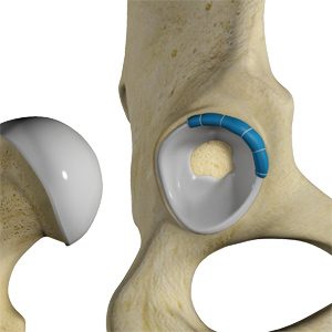 Picture of Hip Labral Reconstruction