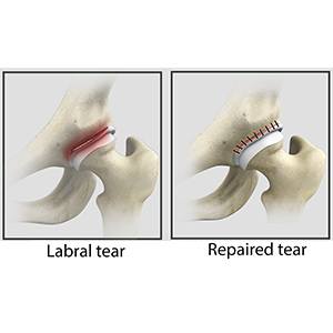 Picture of Hip Labral Repair