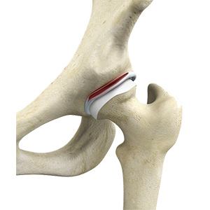 Picture of Hip Labral Tear
