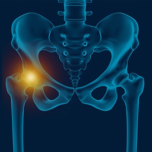 Picture of Hip Pain
