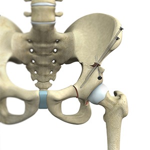 Picture of Hip Preservation Surgery