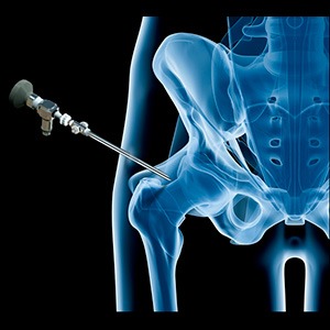 Picture of Hip Surgery