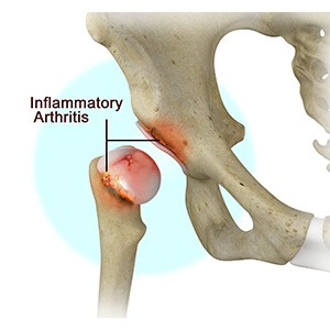 Picture of Inflammatory Arthritis of the Hip