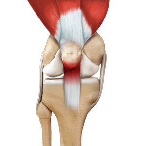 Picture of Jumper's Knee