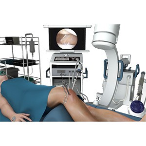 Picture of Knee Arthroscopy