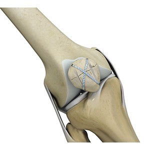 Picture of Knee Fracture Surgery