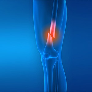 Picture of Knee Fracture