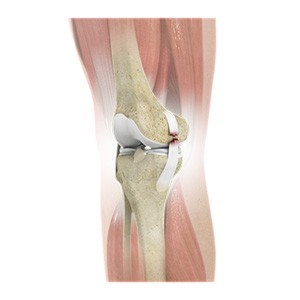Picture of Knee Ligament Injuries
