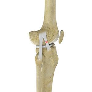 Picture of Knee Sprain