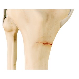 Picture of Knee Stress Fractures