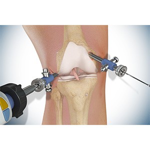 Picture of Knee Surgery
