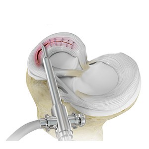 Picture of Meniscal Surgery