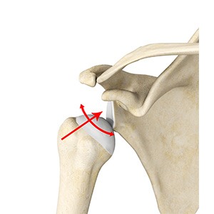 Picture of Multidirectional Instability of the Shoulder