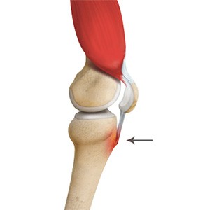 Picture of Osgood Schlatter Disease