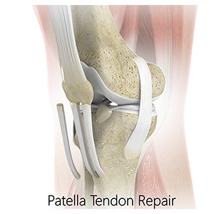 Picture of Patellar Tendon Repair