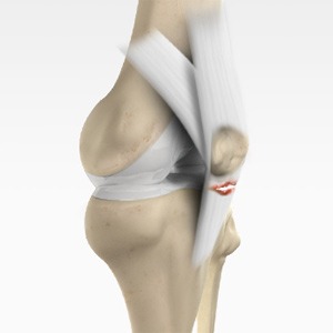 Picture of Patellar Tendon Tear