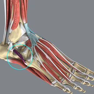 Picture of Peroneal Tendonitis