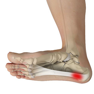 Picture of Plantar Fasciitis