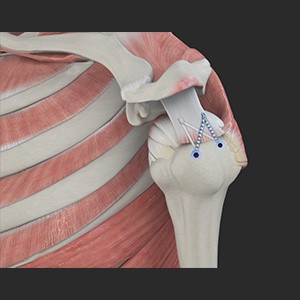 Picture of Rotator Cuff Repair