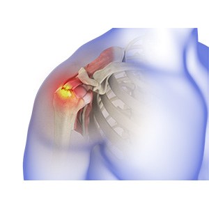 Picture of Rotator Cuff Tear