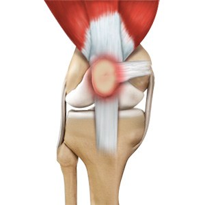 Picture of Runner's Knee