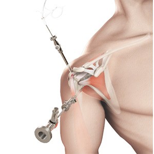 Picture of Shoulder Arthroscopy