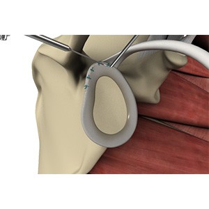 Picture of SLAP Repair