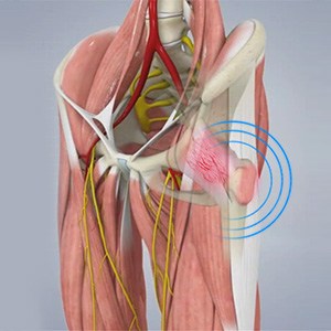 Picture of Snapping Hip Syndrome