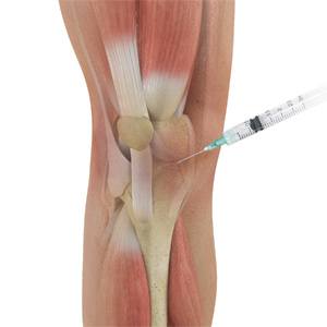 Picture of Steroid Injections