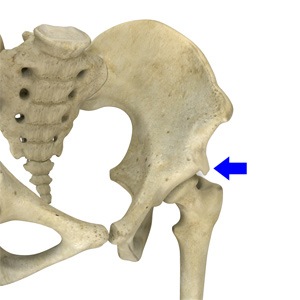 Picture of Subspine Impingement