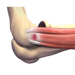 Picture of Tennis Elbow Surgery