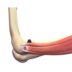 Picture of Tennis Elbow