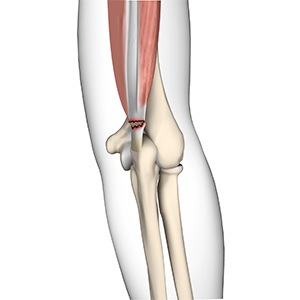 Picture of Triceps Injuries