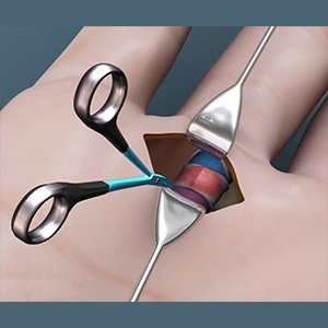 Picture of Trigger Finger Release