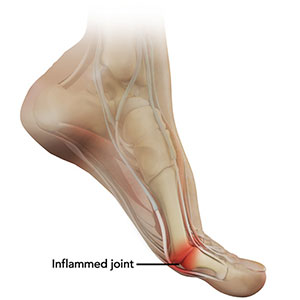 Picture of Turf Toe