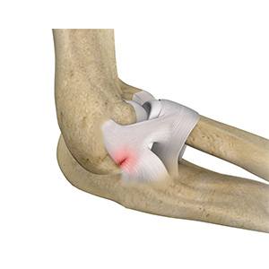 Picture of Ulnar Collateral Ligament (UCL) Injury