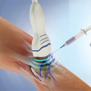 Picture of Ultrasound Guided Injections