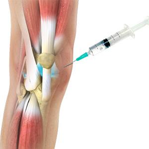 Picture of Viscosupplementation Injections