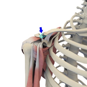 AC Joint Arthroplasty