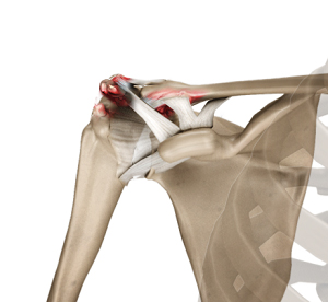 Acromioclavicular (AC) Arthritis img