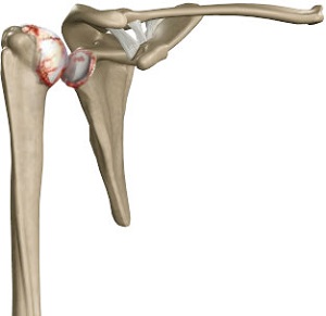 Arthritis of the Shoulder img