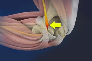 Cubital Tunnel Syndrome (Ulnar Nerve Entrapment)