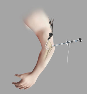 Elbow Arthroscopy-img