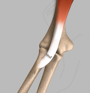 Elbow Flexor Tendon Tear Repair