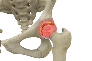 Joint Injuries-img